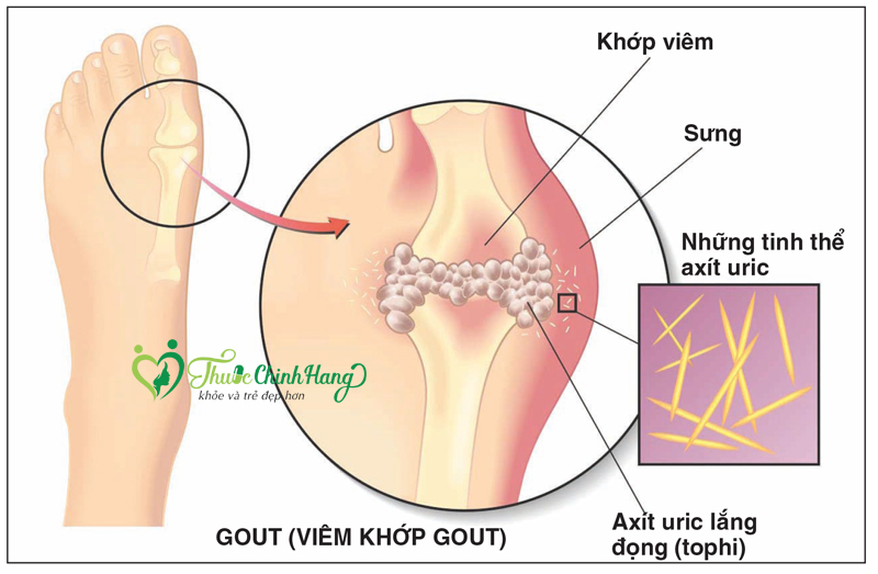 bi-gout-can-kieng-gi.jpg