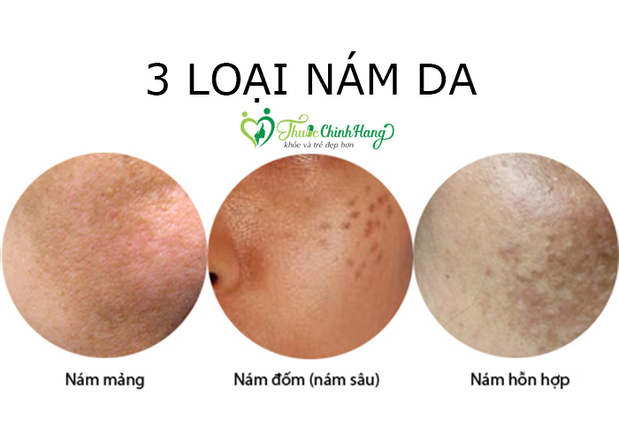 kem-tri-nam-transino-whitening-la-loai-nao.jpg