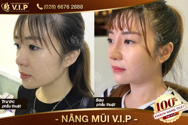 nang-mui-vip-boc-sun-1.jpg