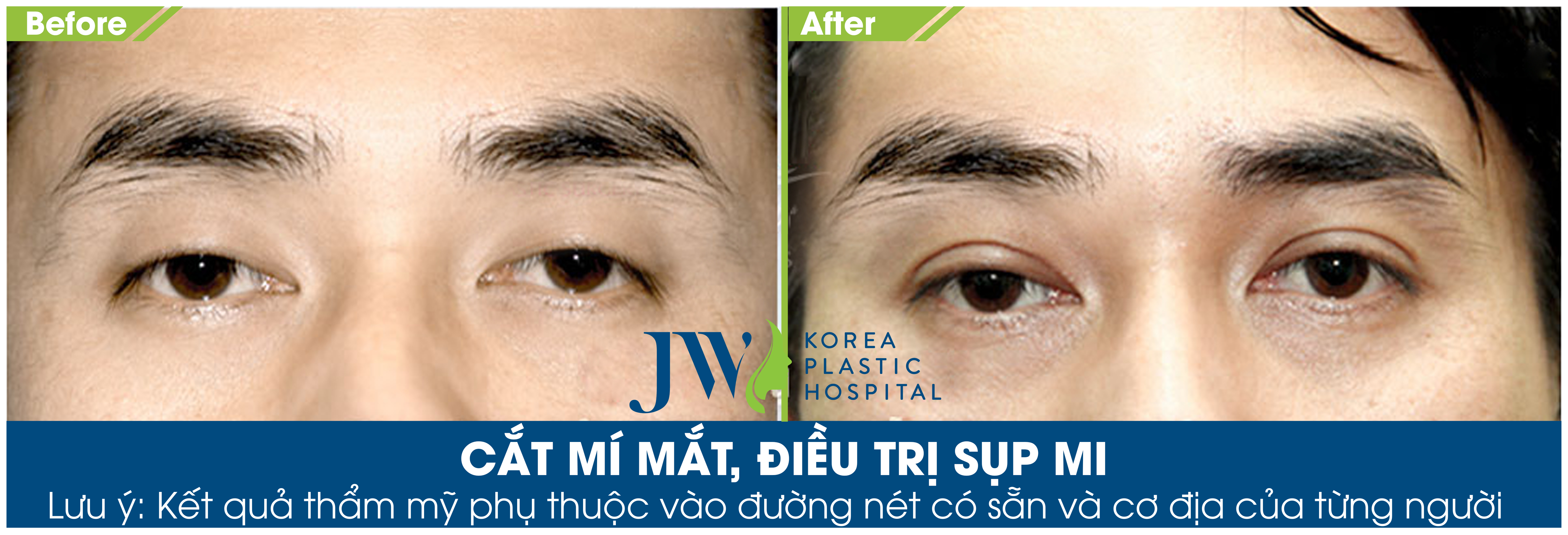cat-mi-mat-dieu-tri-sup-mi.jpg