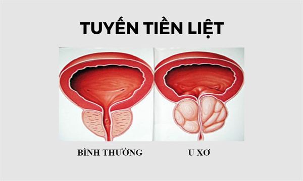 u-xo-tien-liet-tuyen-1.jpg