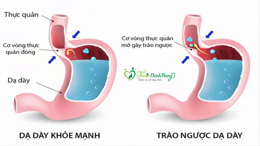nguyen-nhan-gay-mui-hoi-hoi-thoi.jpg