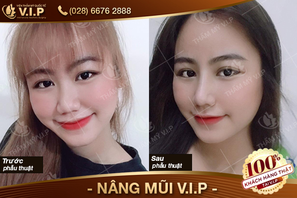 nang-mui-vip-boc-sun-13.jpg