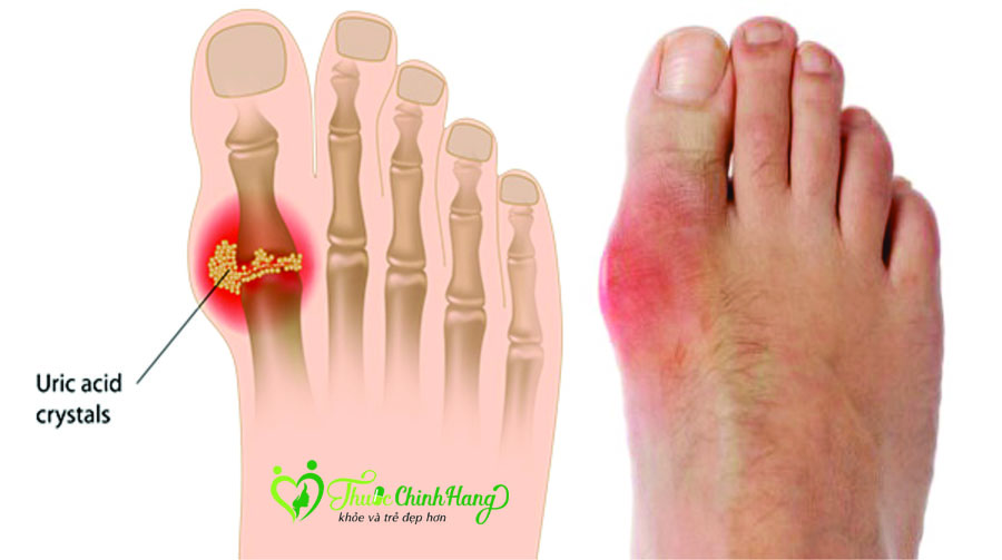 cac-thuc-pham-tot-danh-cho-nguoi-bi-gout.jpg