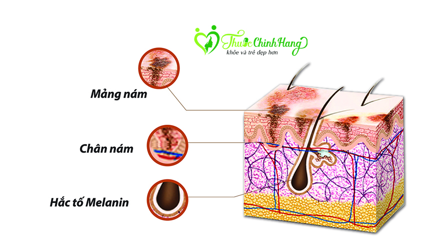 kinh-nghiem-tri-nam-chan-sau-thanh-cong.jpg