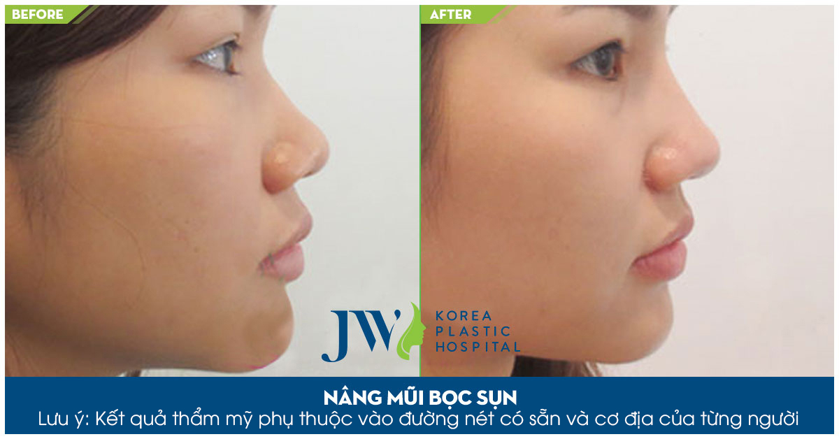 nang-mui-boc-sun.jpg