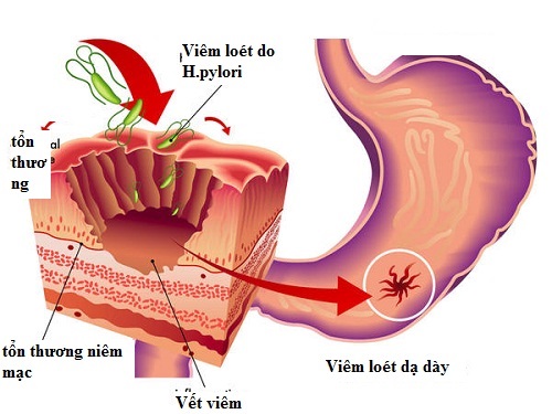 viem-loet-da-day-do-vi-khuan1.jpeg